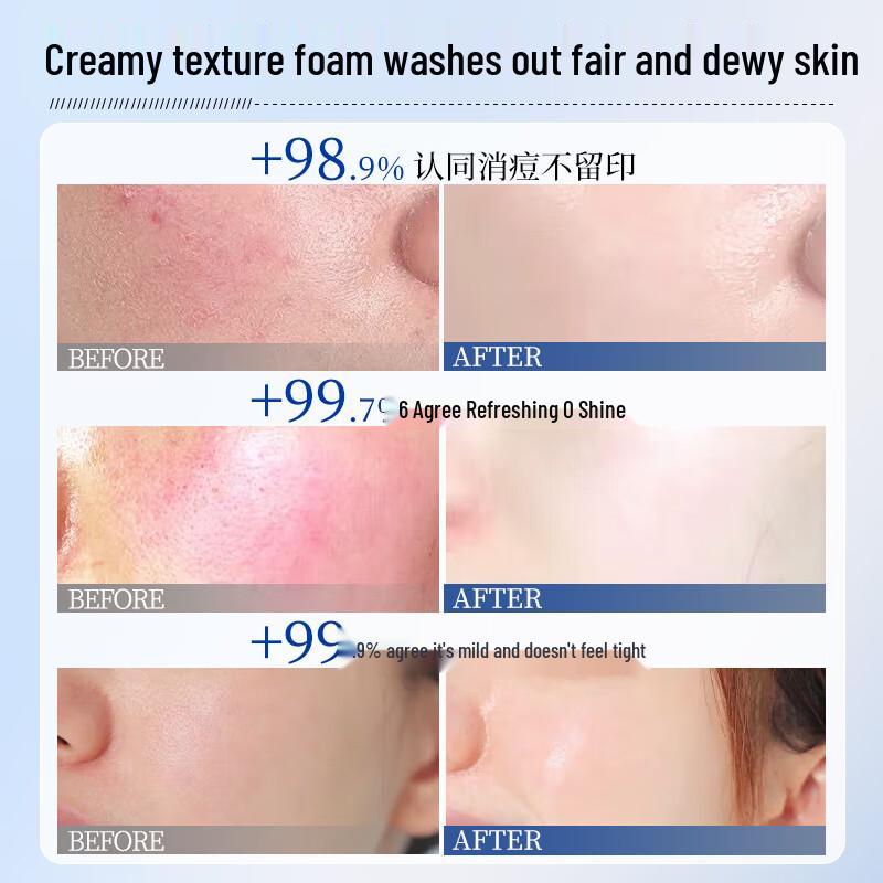 BVSYL Anti-Acne & Oil Control Facial Cleanser