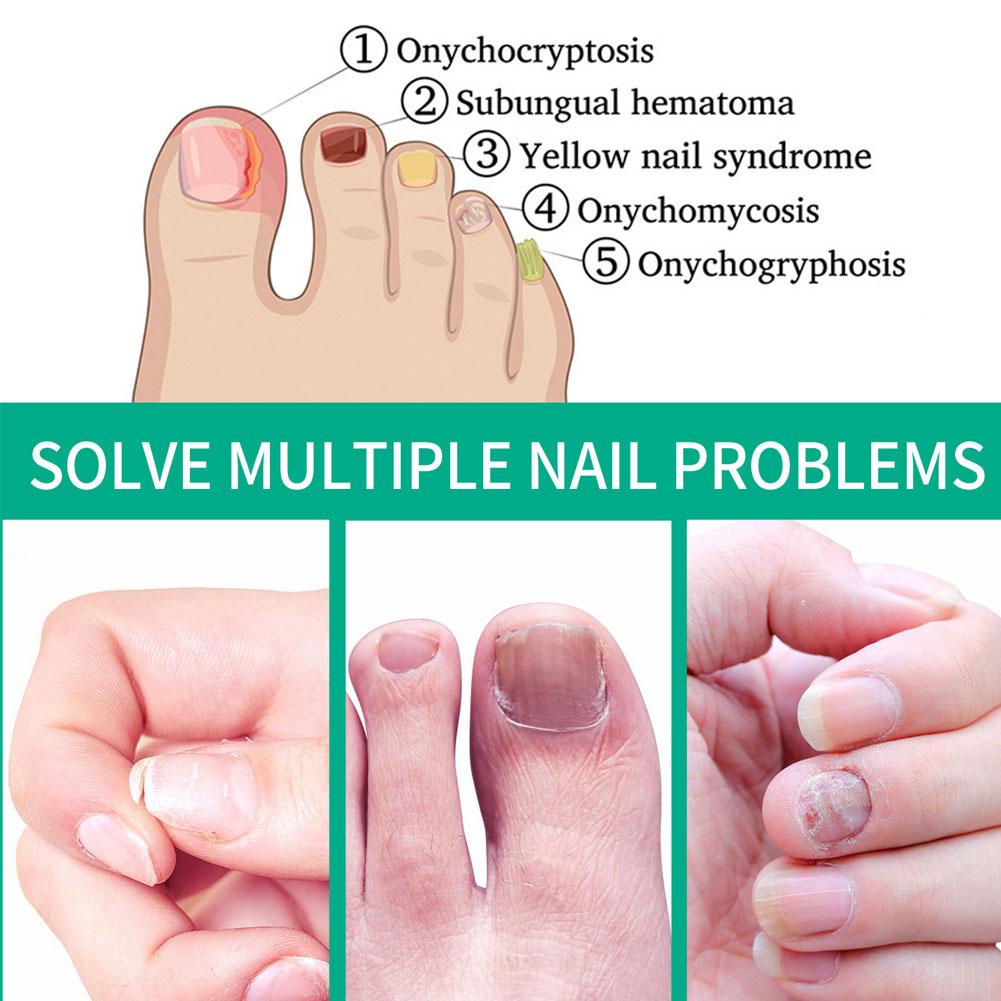 5Pcs Extra Strong Nail Fungus Treatment Serum Essence Care Repair Essence Anti Toe Infection Gel Feet Serum Removal Nails Fungal