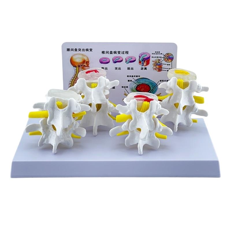 

Human Skeleton Model for Anatomy Lumbar Spine 4 Stages Lesions Comparative Model Lumbar Vertebrae Model Nursing Model 1