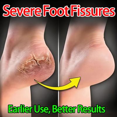 Deep Moisturizing, Gentle Curing Chapped Hands and Feet Cream