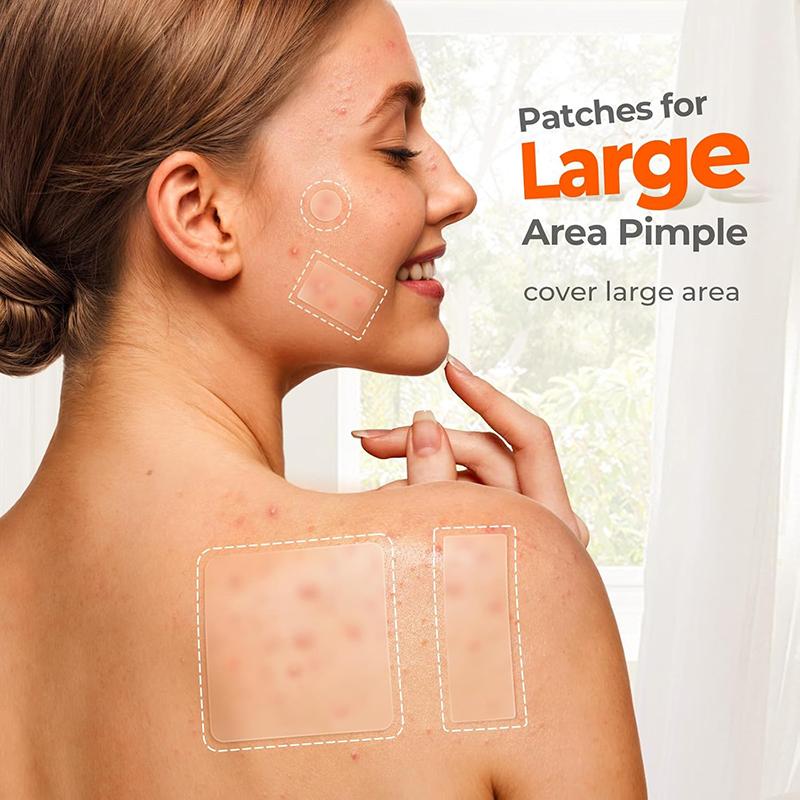 302Pcs Acne Patch Repair Acne Cleansing Invisible Breathable Waterproof Acne