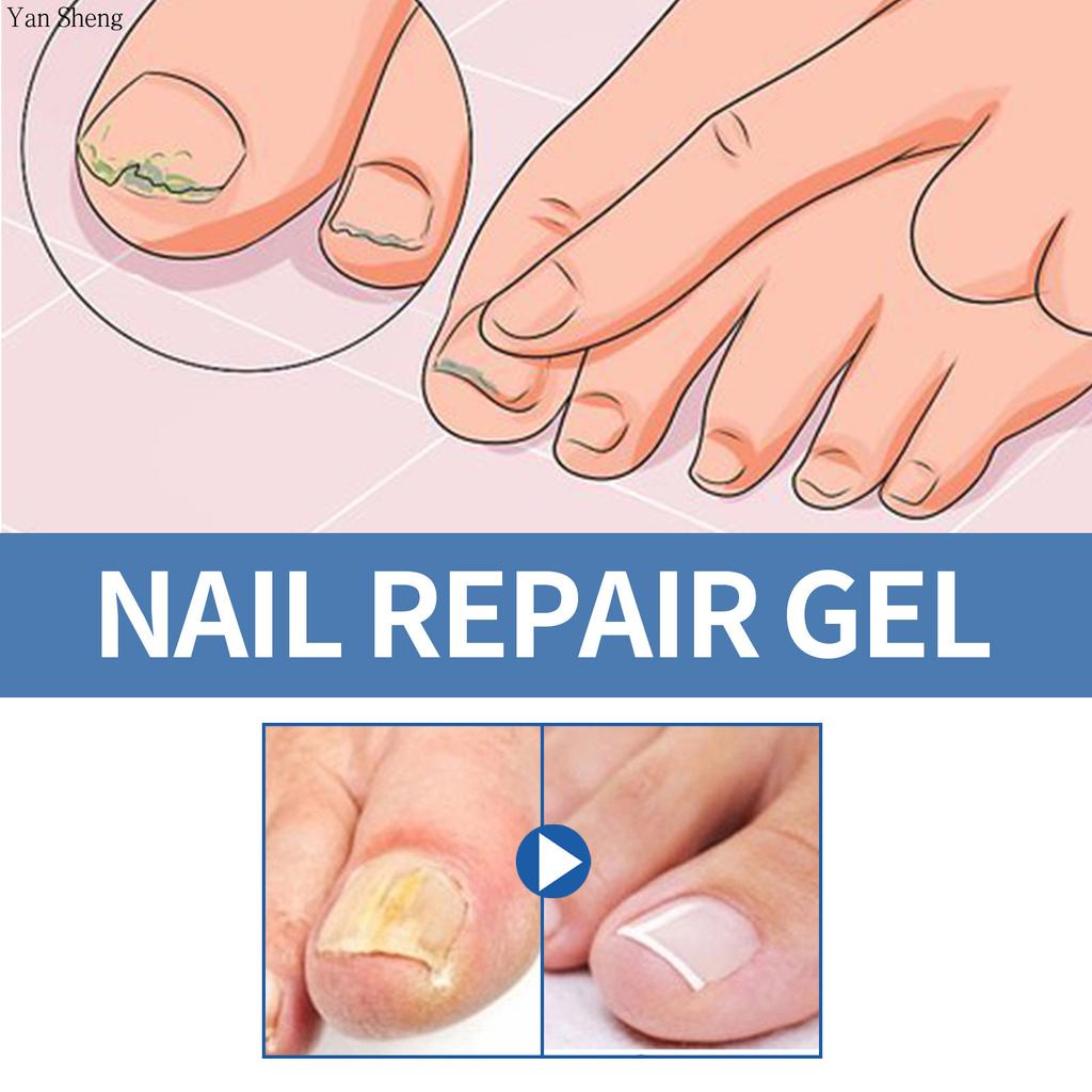 Nail Care Gel Hand Foot Onychomycosis Soft Nail Thickening Nail Luminescent Nail Repair Gel