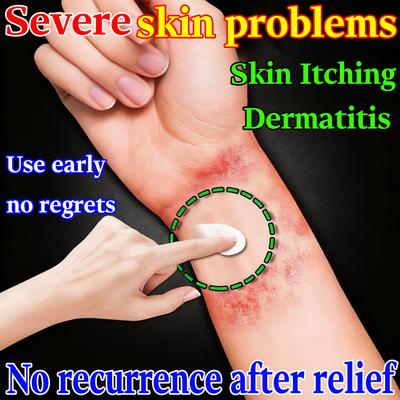 Herbal Gentle Eczema Cream - Relieves Dermatitis Calms Itchy Skin Safe for Sensitive Types