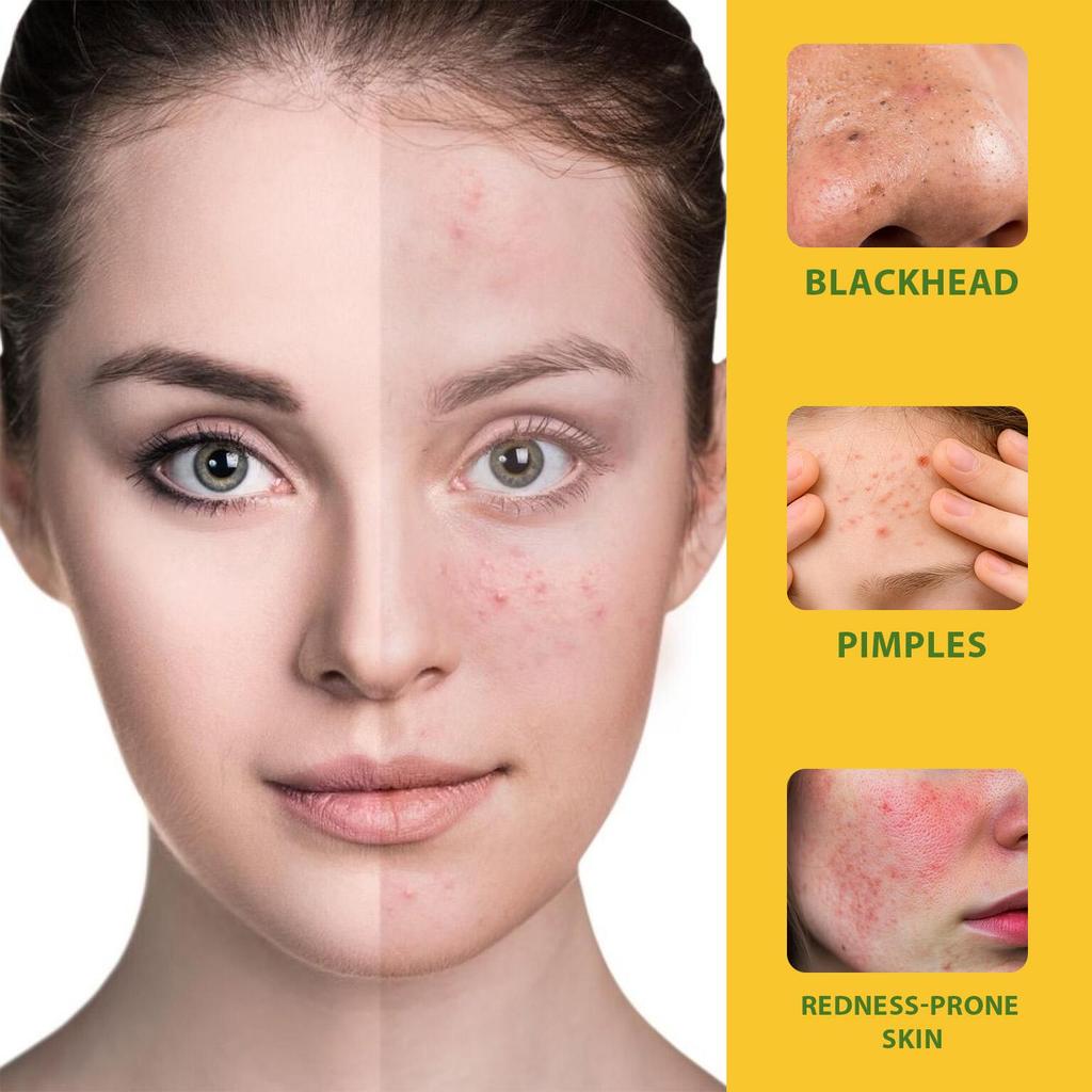 Ginseng Herbal Acne Cream- 24-Hour Long-Lasting Oil Control and Anti-Pimple Protection for Sensitive Skin, 50g