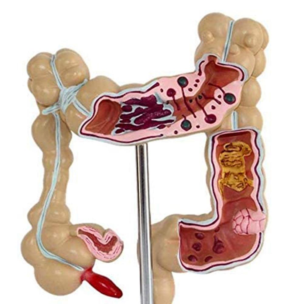 

2025+ Pathological Colorectal Model Large Intestine Model Gastrointestinal Anatomical Model China Mainland
