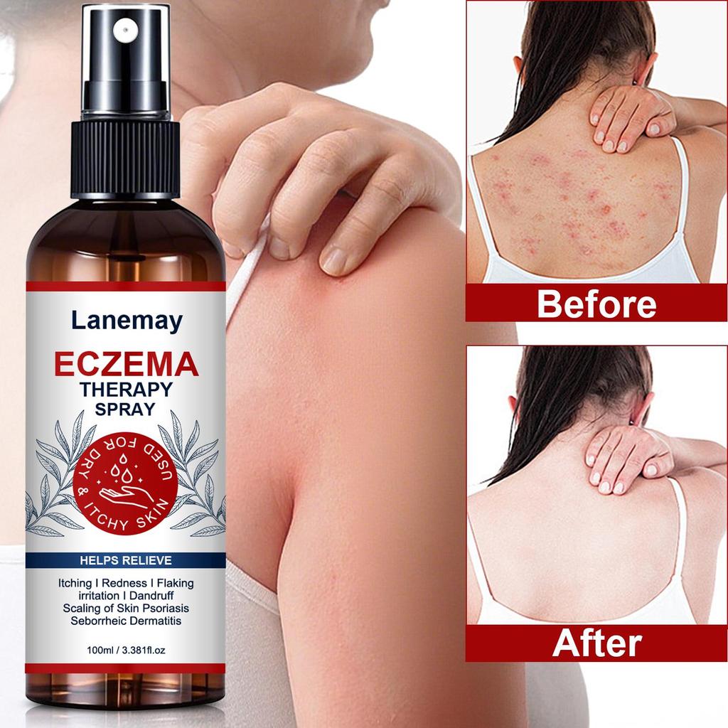 Eczema Therapy Spray-Eczema Treatment-Reduce Itchness And Redness-Prompte New Skin Cell Renewal, 100ml