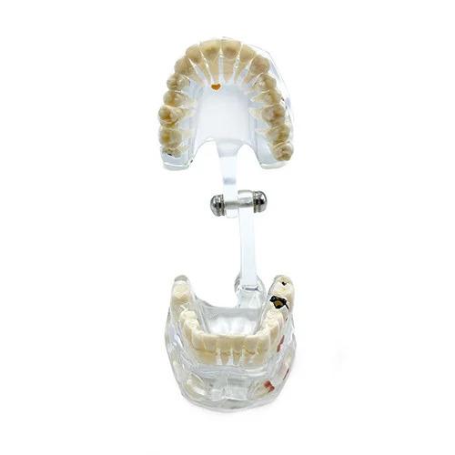 Dental Educational Model, Zamo®, Used To Exemplify Dental Pathologies, 31 Teeth, Transparent