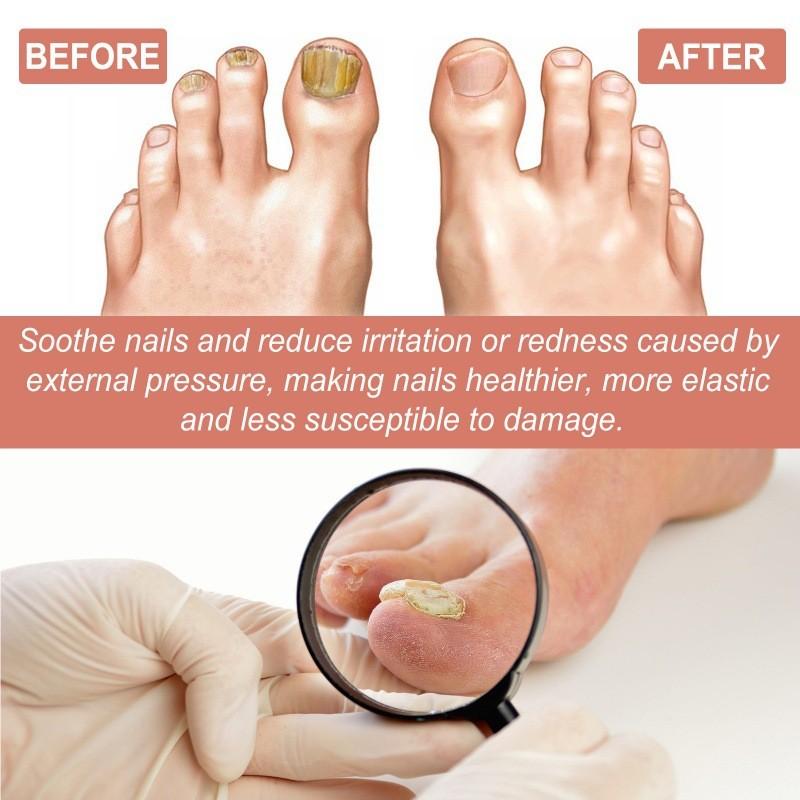 Revitalizing Ouhoe 7 Day Nail Repair Essence For Healthy Strong Nails And Toenails