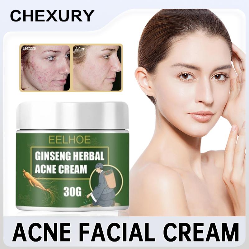 Herbal Acne Cream Treatment Acne Acne Scar Shrink Pore Oil Control