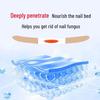 Guo Yi Onychomycosis Patch: Nail & Toe Care for Gray Nails