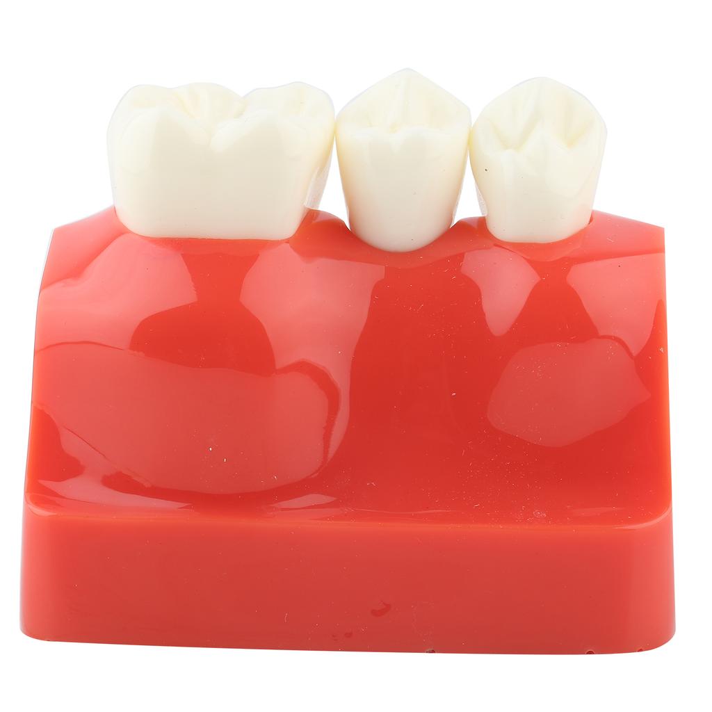 1pc Resin Dental Demonstration Tooth Model Implant Analysis Crown Bridge for Dentist