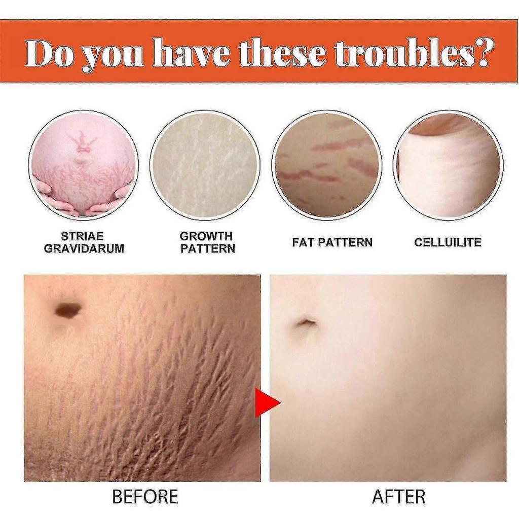 3x Stretch Marks Removal Cream Fat Growth Streaks Maternity Scars Acne Repair Increase Skin Elasticity Anti-wrinkle Firm Body Care