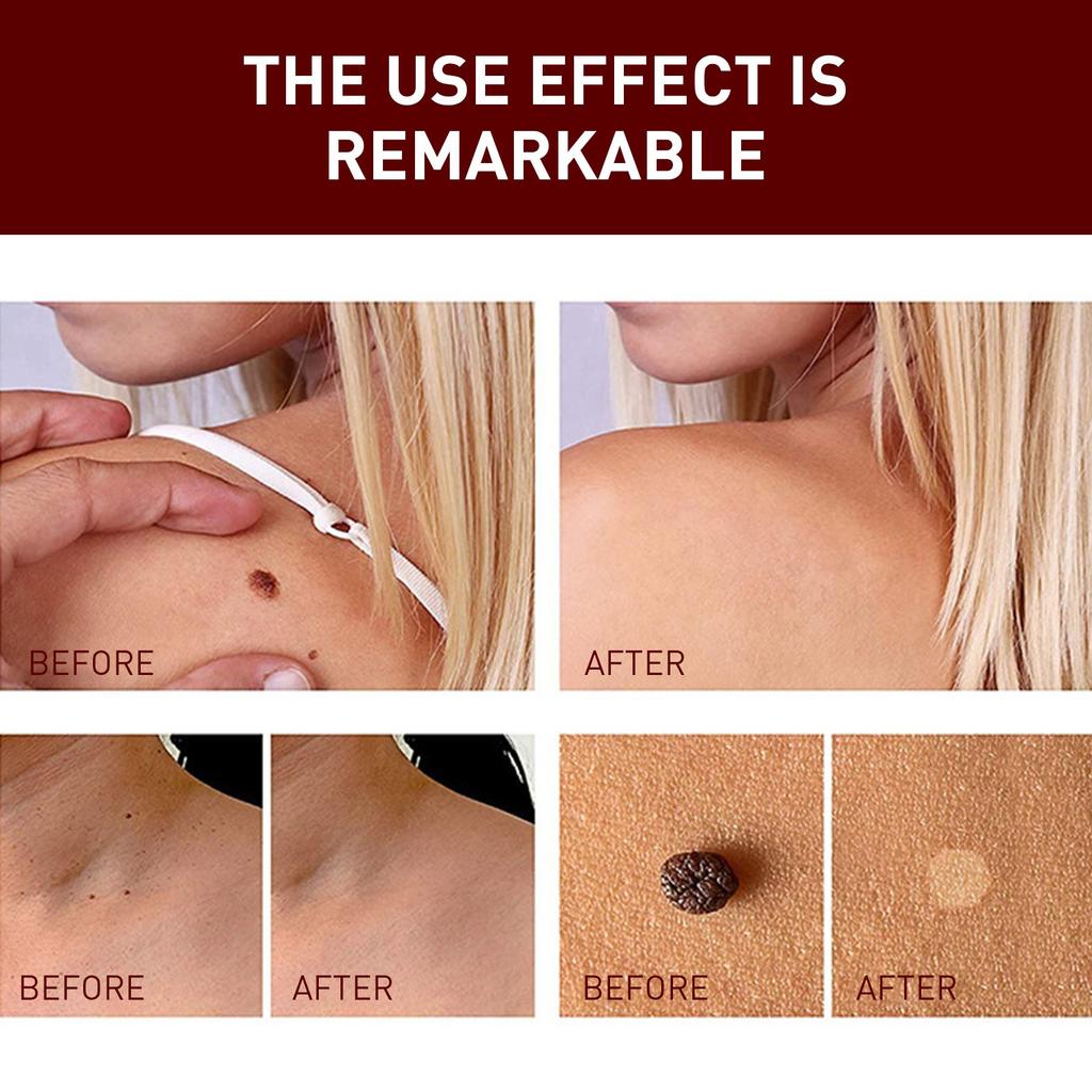 Tags & Moles Remover, WipeOff Tags & Moles Remover, WipeOff Remover 3ML