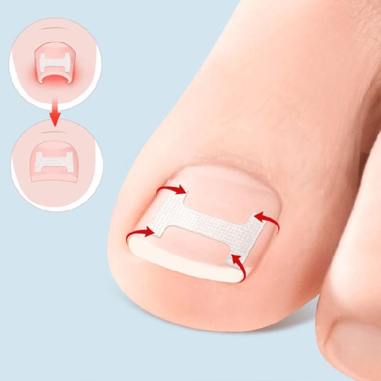 Ingrown Toenail Corrector Patches,Ingrown Toenail Treatments Tool Foot Care,10pcs Ingrown Toenail Corrector Strips