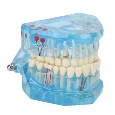 Dental Pathological Model Clear Teaching Detachable Dental Teeth Display Model Blue Transparent