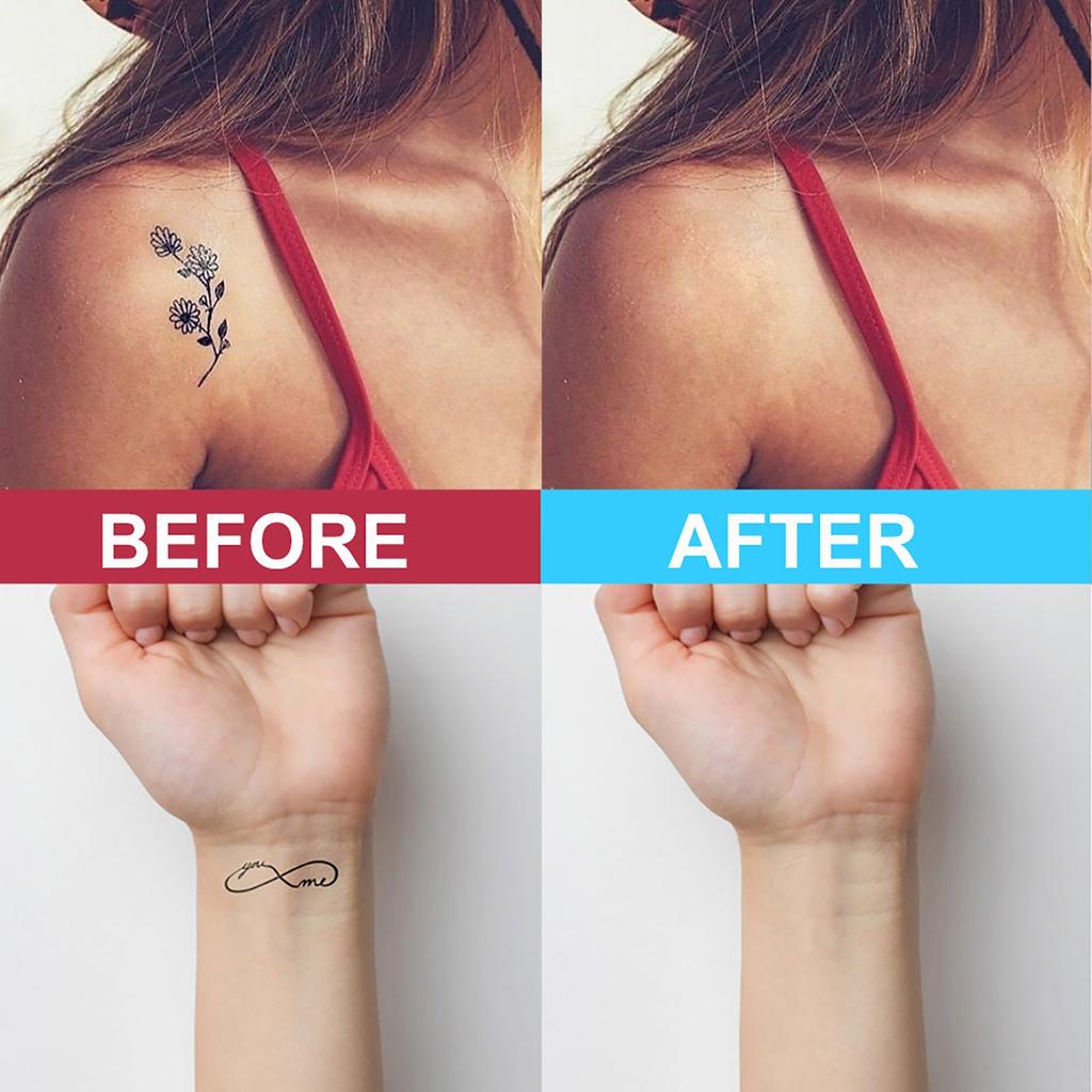  Removal  Permanent Removal Of s  Removal 