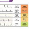 Yousheng EKG Rhythm Interpretation Card Portable Reference Badge Card Electrocardiogram Rapid Interpretation Guide Horizontal Vertical Layout Cheat