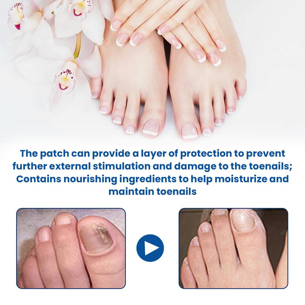 Patchs Réparateurs pour Ongles d'Orteil Ximonth Pour Soin Nourrissant et Adoucissant des Ongles Fongiques