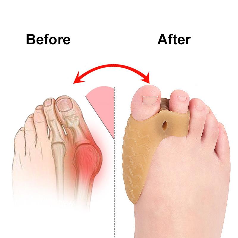 Pexmen 2 Stück Ballenkorrektur Zehenspreizer Hallux Valgus Weichgel Ballenpolster Unterstützung für überlappende Zehen für Männer und Frauen