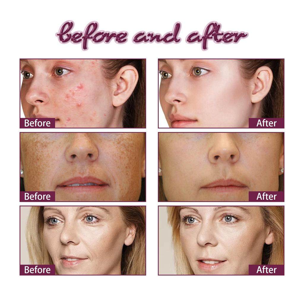 EELHOE Begonia Facial Oil Fades Acne Marks, Lightens Lines, Moisturizes & Firms Skin Essential Oil