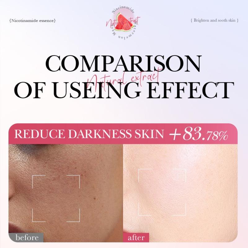 3pcs Watermelon Niacinamide Essence Mask 25ml Hydrating Moisturizing Mask Skin Care Products