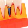 Dental 4 Times Implant Teeth Model Analysis Crown Bridge Demonstration Removable Model Dentistry Study Training Teaching Model