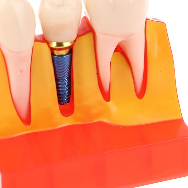 Dental 4 Times Implant Teeth Model Analysis Crown Bridge Demonstration Removable Model Dentistry Study Training Teaching Model