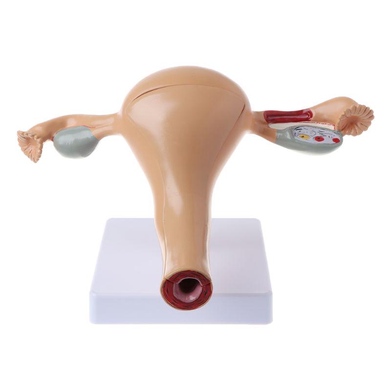 Human Pathological Uterus Ovary Model Anatomical Anatomy Disease Pathology Medical Lesion Teaching