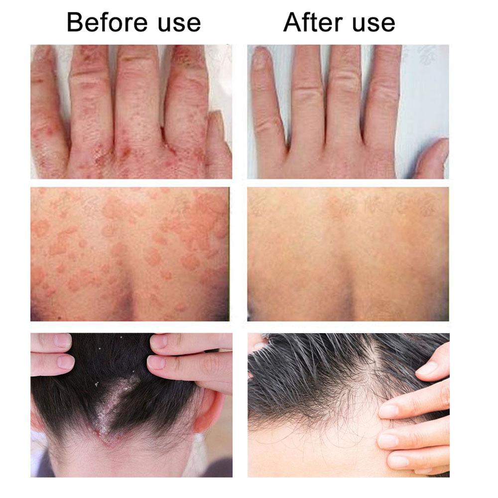 Skin Antipruritic Care Cream Body Moisturizing Repair Nourishing Cream