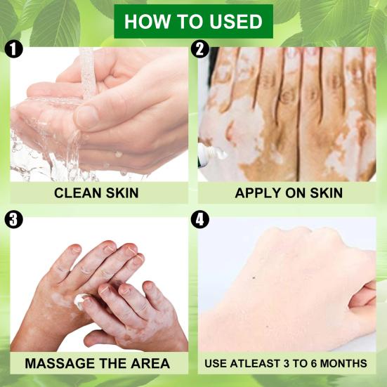 20 g White-Tag-Creme, einzigartige Verwendung von Pflanzenextrakten, therapeutische Vitiligo-Creme