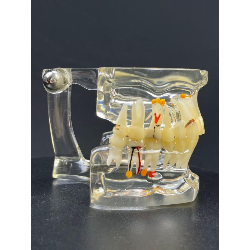 Прозора Знімна Повна Модель Щелепи з М'якими Яснами та Зубами для Підготовки до Імплантації