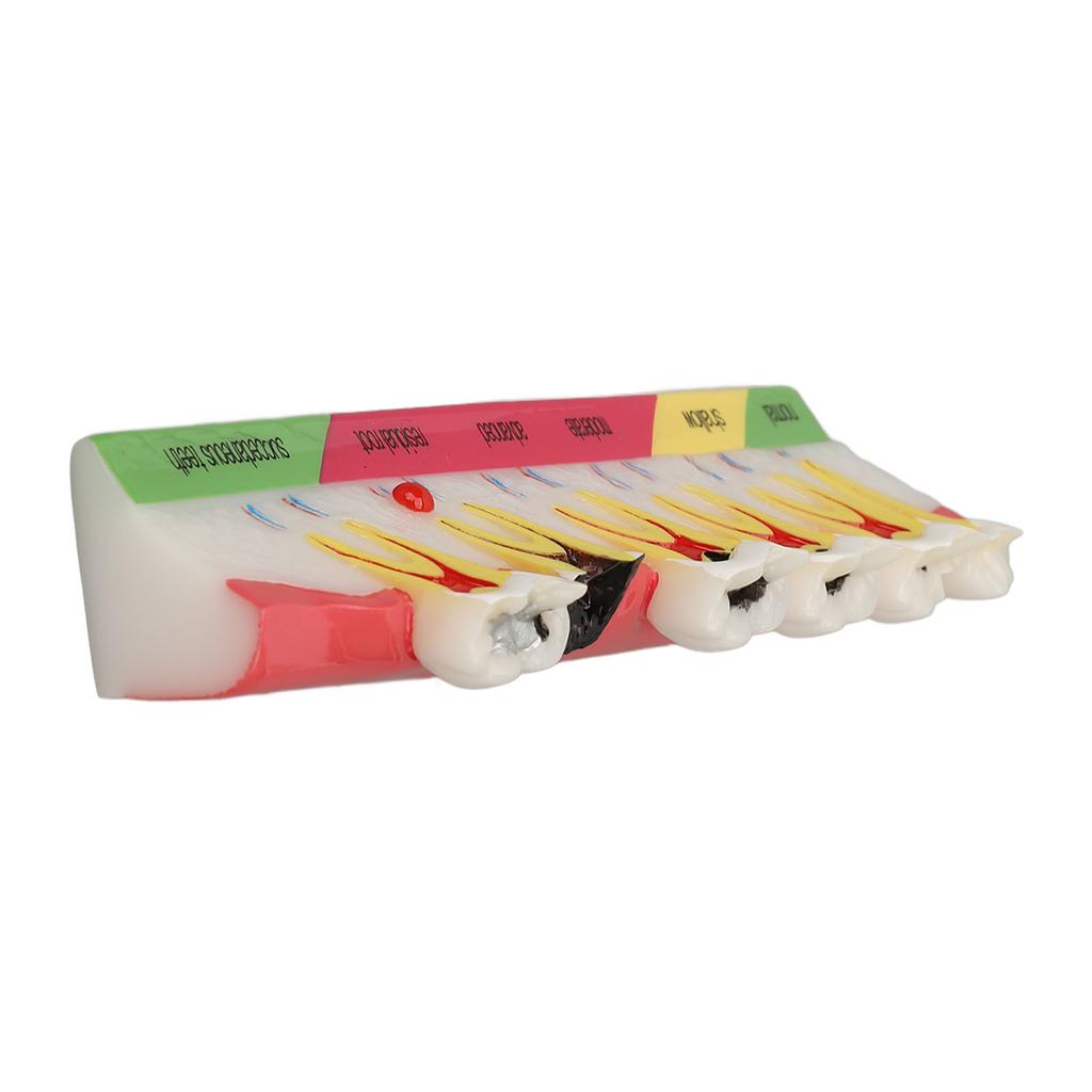 Dental Caries Model 6 Different Stages Resin Decayed Tooth Display Model