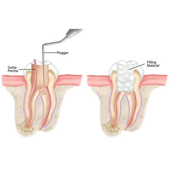GDC Iso Sized Plugger -7 (.60mm) (Rcpcc60)