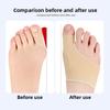 SEBS Hallux Valgus Care Cover, Big Toe Bone, Hallux Valgus Protective Cover, Big Foot Protective Cover