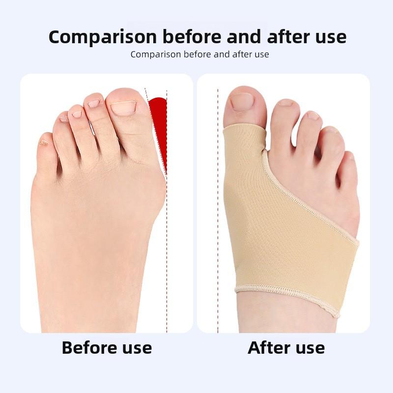 SEBS Hallux Valgus Care Cover, Big Toe Bone, Hallux Valgus Protective Cover, Big Foot Protective Cover