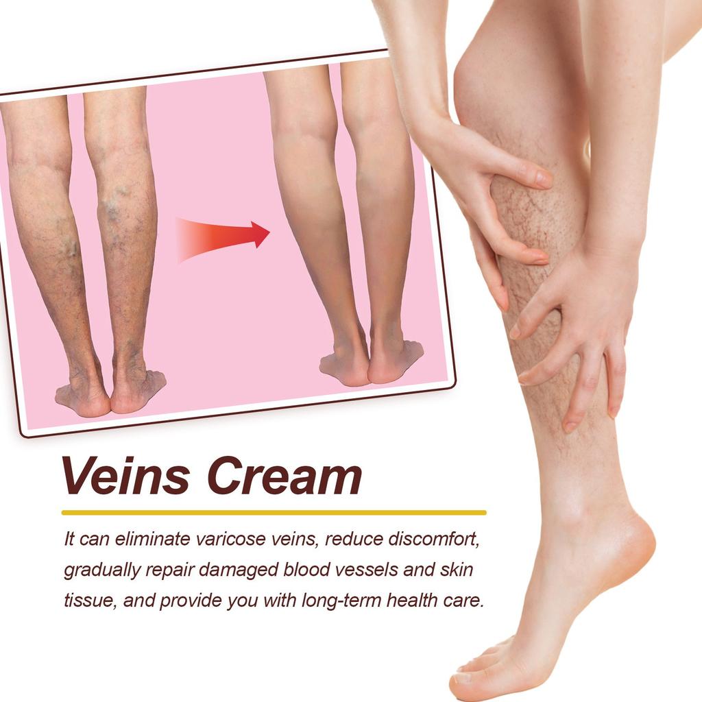 Vein Care Fading Paste -Anti Varicose Vein Soothing Leg Paste,  The Appearance Of Varicose Veins