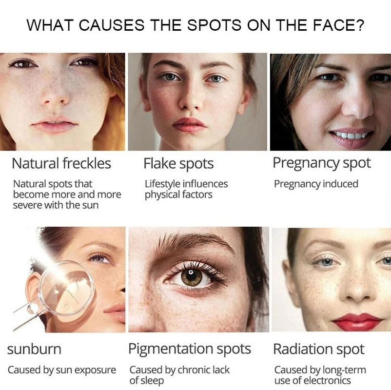 Newest Whitening Facial Cream Repair Fade Freckles Remove Dark Spots Melanin Remover Brightening Face Freckle Cream