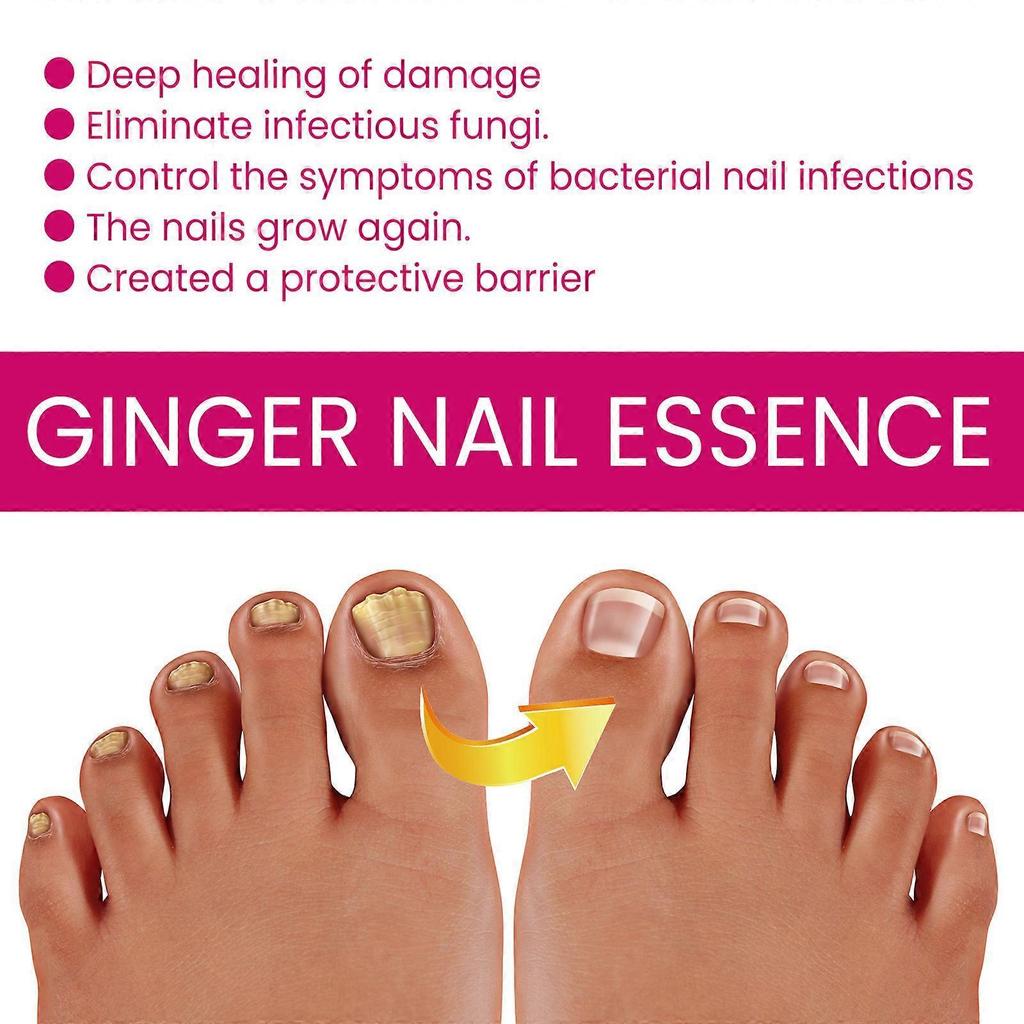 1-5x OUHOE Ingwer Nagelpflege Essenz, Graue Nägel Feuchtigkeitspflege Peeling Schönheitsnagel Essenz