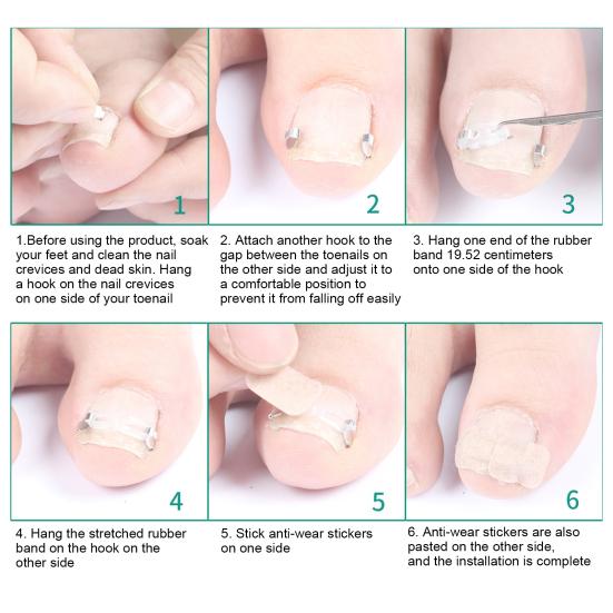 Ingrown Toenail Corrector Kit for Curved Nail Stainless Steel Armor Buckle Toe Nail Straightener Ingrown Nail Tool