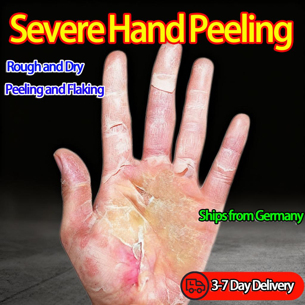 Powerful Hand Peeling Healing Cream, Special for Peeling and Chipping, Deep Repair of Damaged Skin