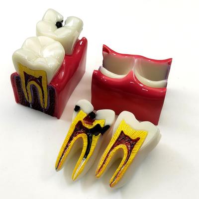 1ks dentální anatomie vzdělávací model zubů 6krát srovnávací modely zubního kazu studijní modely pro zubní lékaře studující a zkoumající