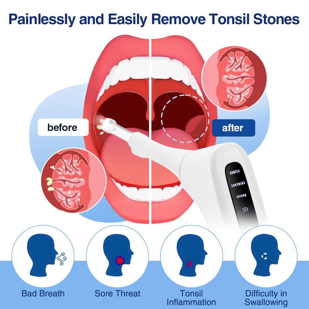 Tonsil Stone Remover Tool Electric Vacuum Tonsil Stone Removal Kit LED Light & 3-Level Suction Tonsil Cleaner Anti Bad Breath