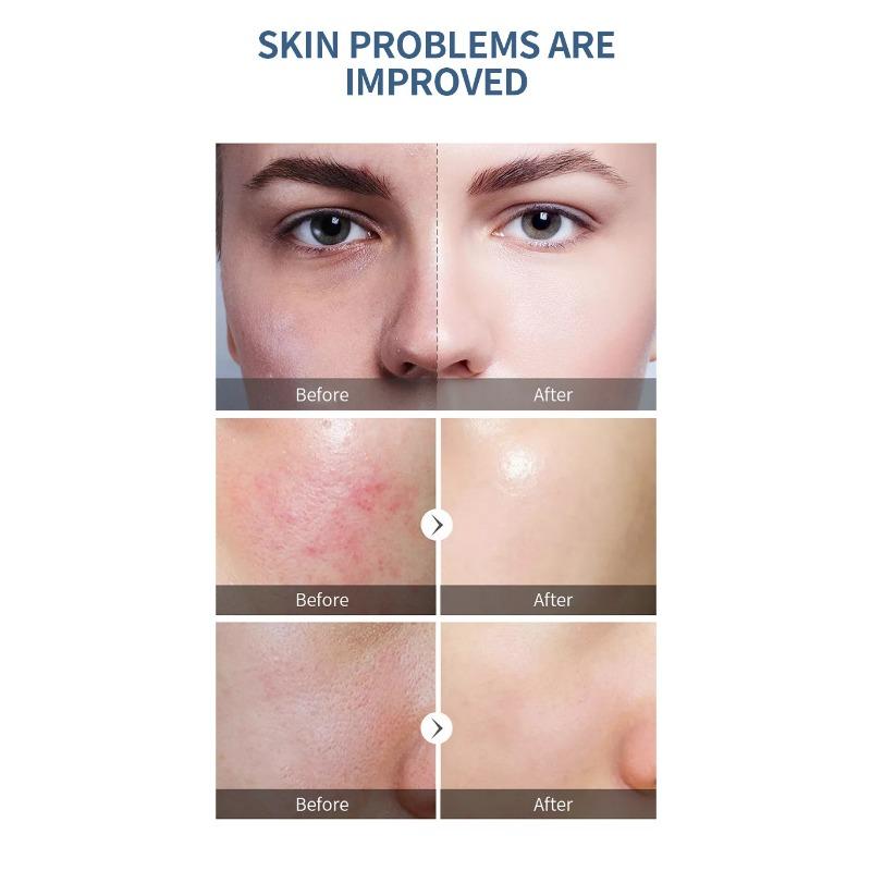 Essence Salicylic Acid Acne Removal HBA Fruit Acid Desalinates Acne Pit Pit Pit Closed