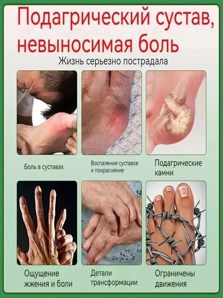 Professional gout patches for gout treatment hallux valgus arthritis relieve swelling and pain relief