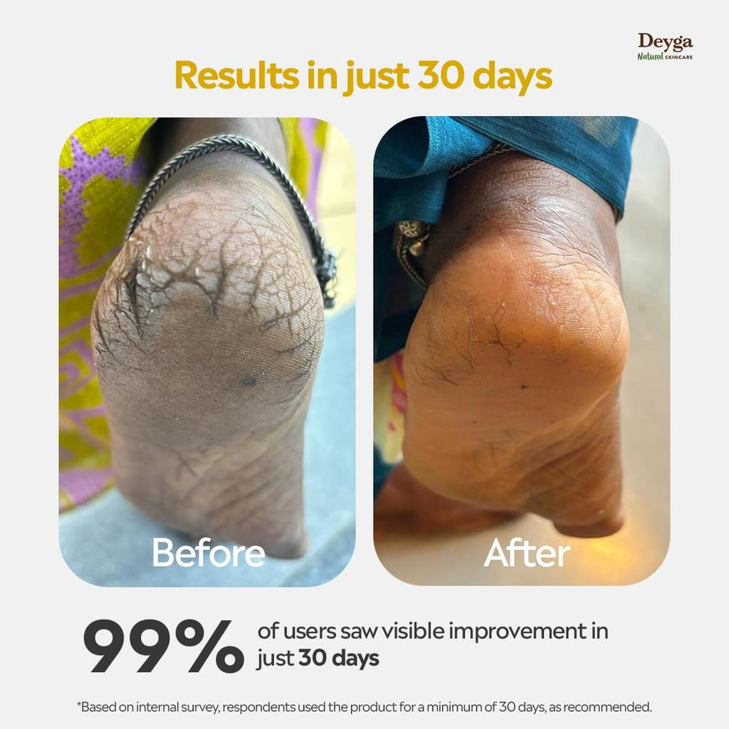Deyga Foot Cream Trial Pack | For Dry And Cracked Feet | Moisturizes Rough Heels | Suitable For All Skin Types| Foot Butter For Men & Women| Preven