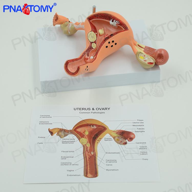 Female Uterus and Ovary Pathology Model for Gynecology and Obstetrics Teaching 7.9×5.9×5.1in