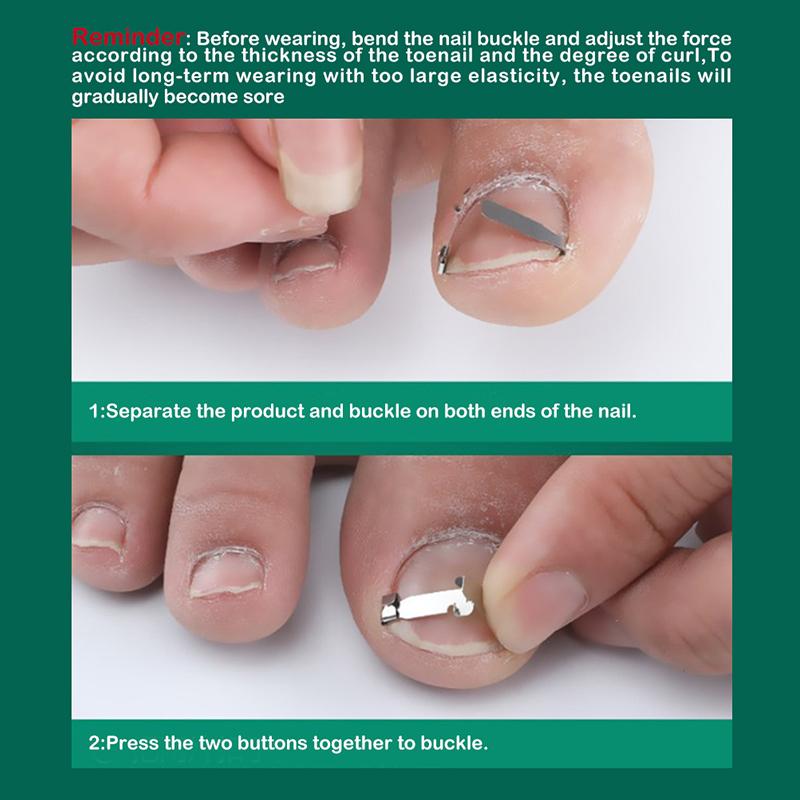 Ingrown Toenail Tools, Ingrown Toenail Correction Buckle And Toenail