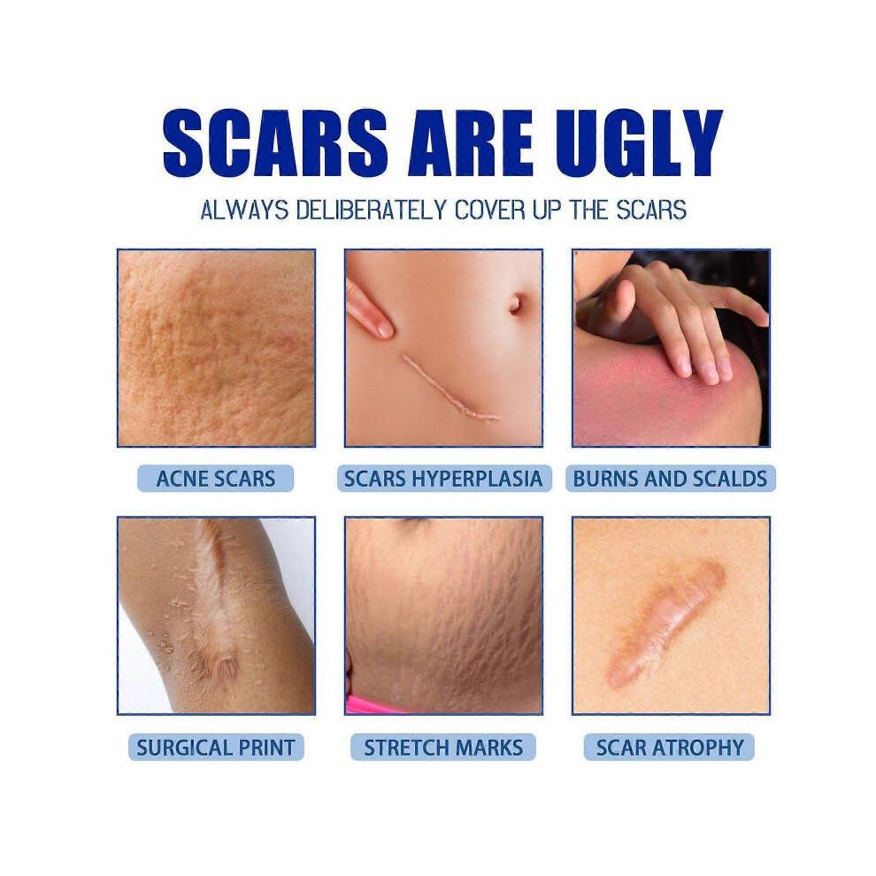 (1pcs)1-3pcs Scar Removal Cream Scar Gel for Surgical Scars, Stretch Marks, Keloid Bump
