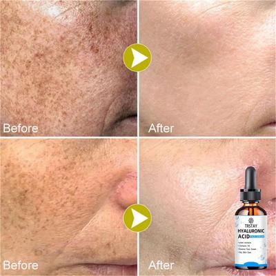 Retinol Face Serum 2.5% With Hyaluronic Acid Anti Wrinkle Whitening Moisturizing Brightening Retinol Essence Skin Care
