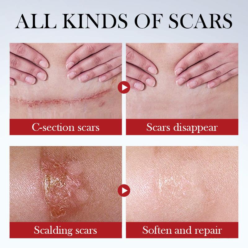 Scar Repair Cream, Scald Scar Moisturizing and Rejuvenating Cream